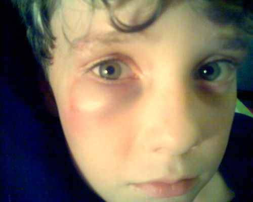 Black Eye